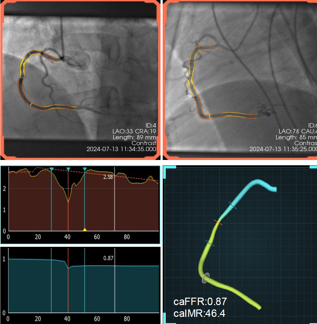 2D-to-3D Coronary Artery Reconstruction