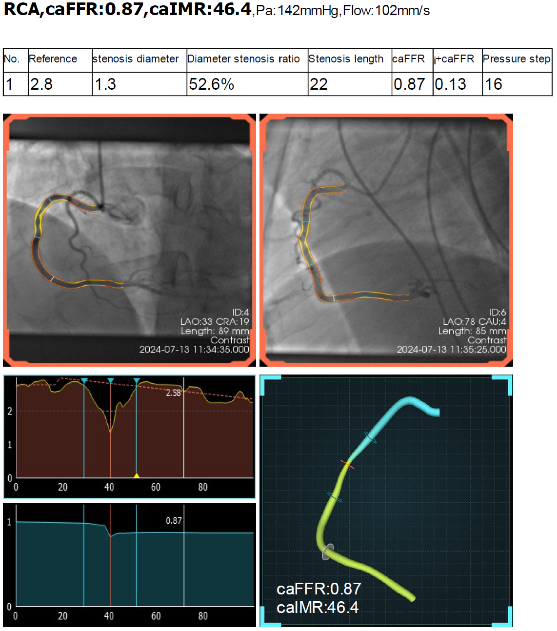 Sample 2D-3D_Reconstruction and vFFR Analysis Report for Real Data