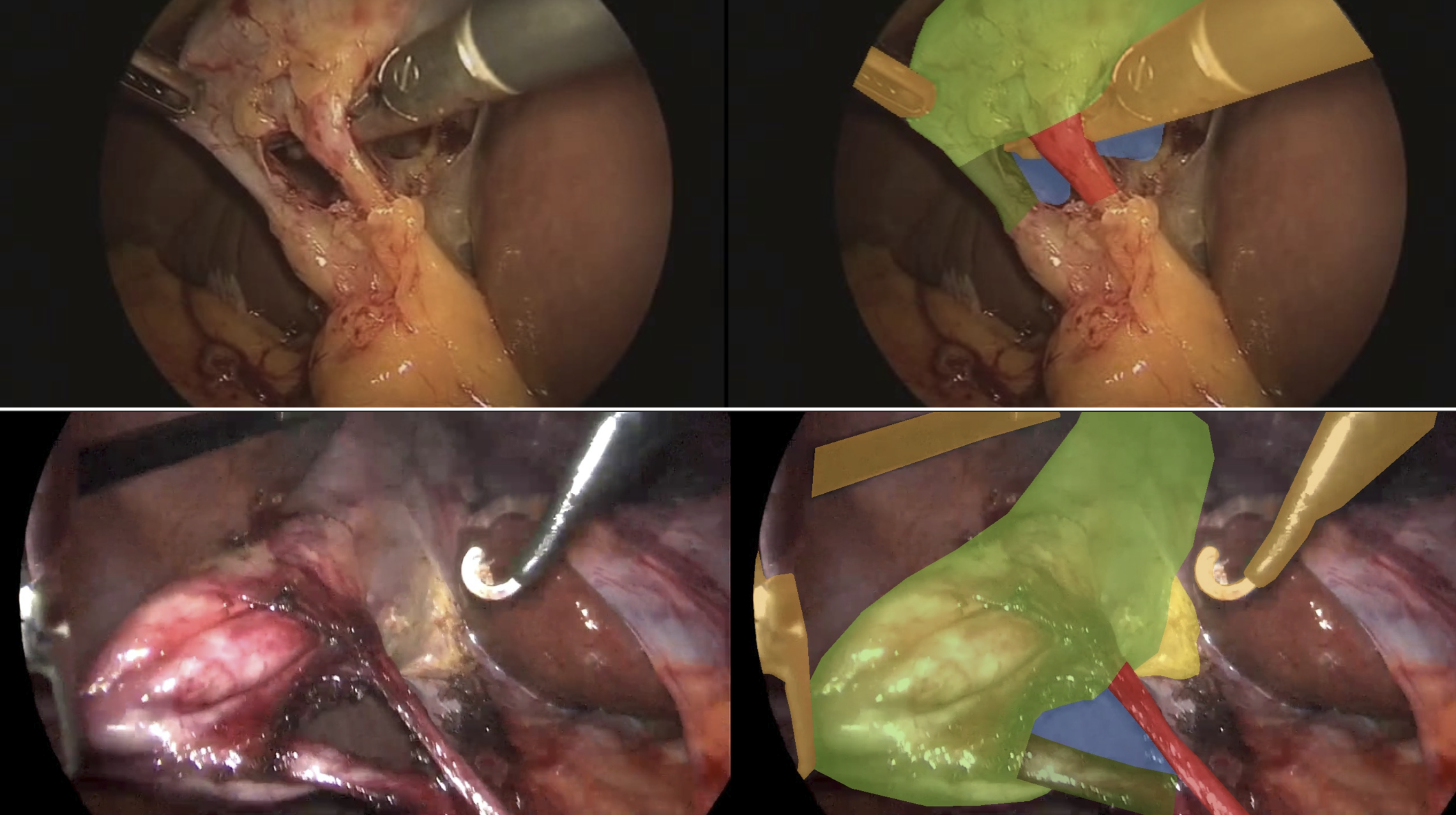 CVS Classification and hepatocystic anatomy segmentation in laparoscopic